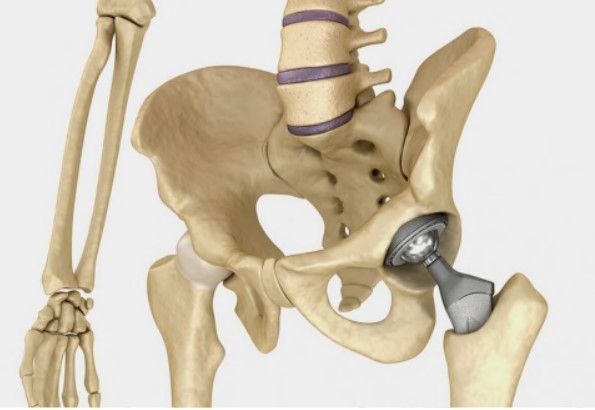 Процедура эндопротезирования тазобедренного сустава