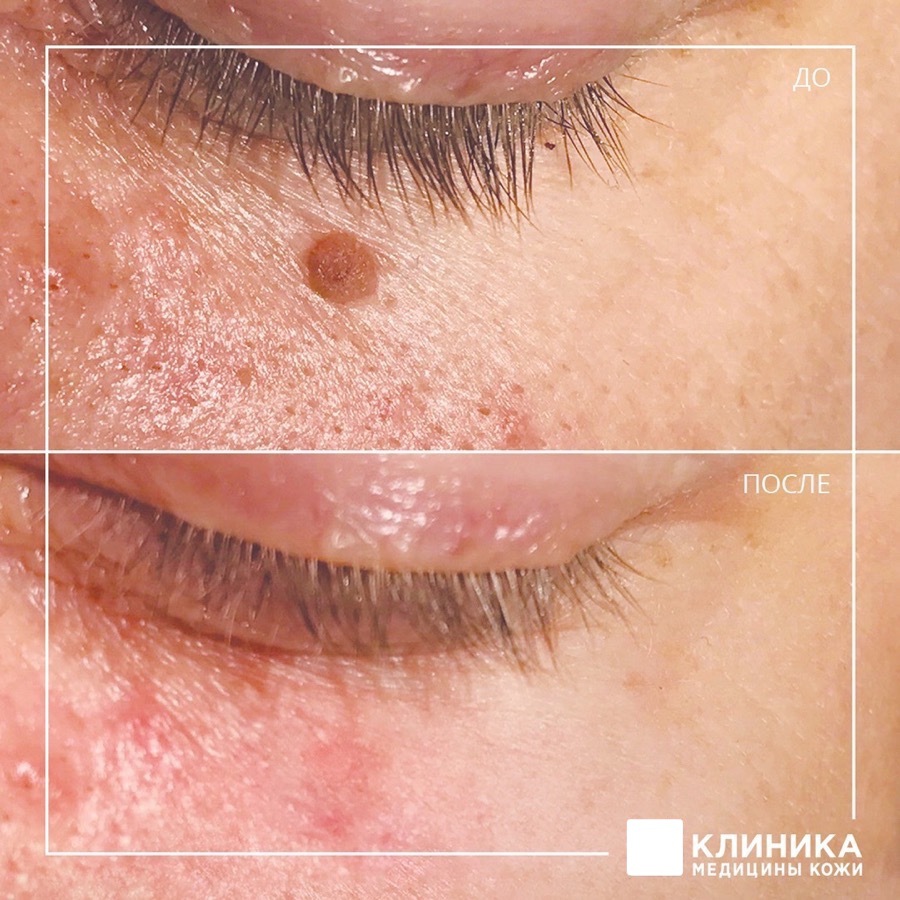 Удаление родинок: зачем, когда и каким способом лучше проводить процедуру