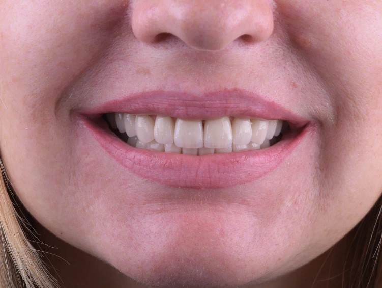 Виниры без обточки зубов: красивая улыбка без страха и сверления