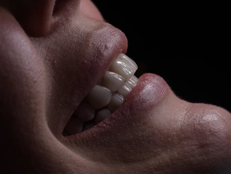 Виниры без обточки зубов: красивая улыбка без страха и сверления