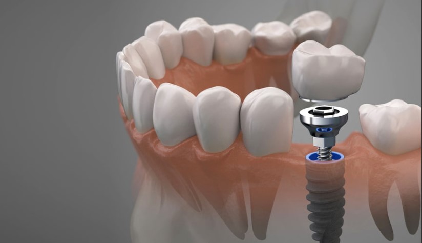 Имплантация зубов: современный подход к восстановлению улыбки