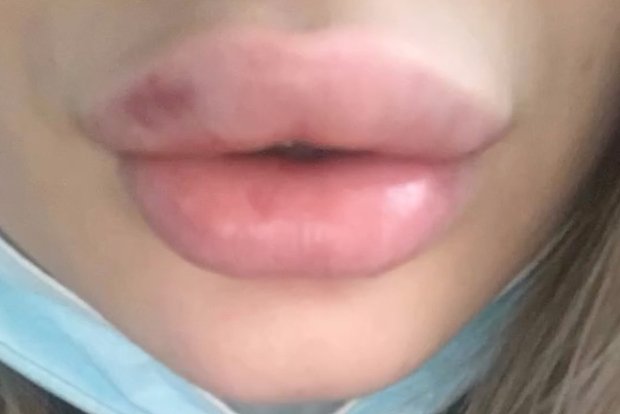 Российская блогерша Аня Мао навсегда осталась с эффектом утиных губ после филлеров