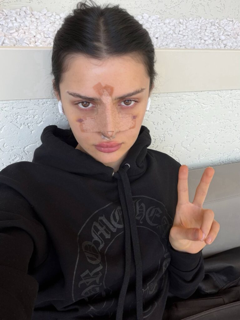 Блогерша Дина Саева снялась после ринопластики